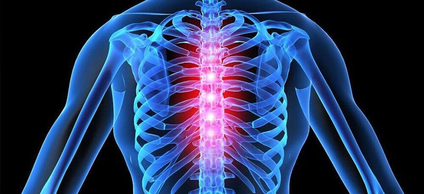 Il dolore acuto è caratteristico dell'esacerbazione dell'osteocondrosi della colonna vertebrale toracica