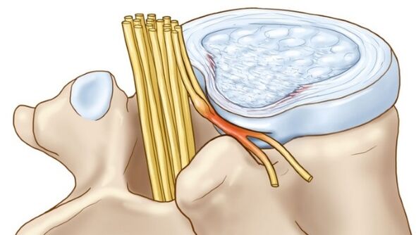 Le sporgenze del disco intervertebrale che si verificano nell'osteocondrosi toracica comprimono le terminazioni nervose
