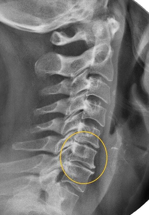 osteocondrosi