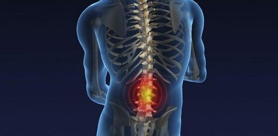 Mal di schiena con osteocondosi del lombare