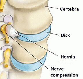 Osteocondrosi della regione cervicale