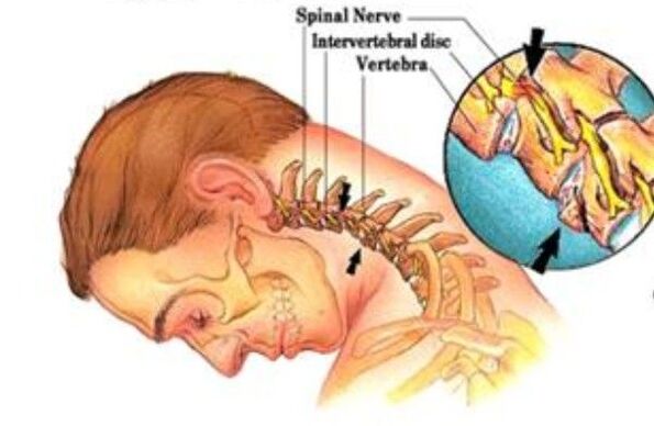 osteocondrosi cervicale