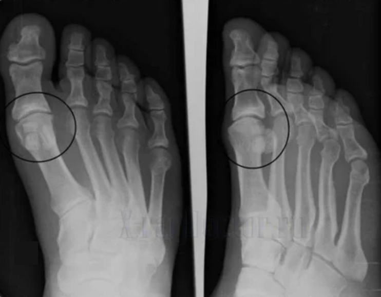 Diagnosi di artrosi