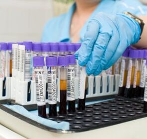 esame del sangue per diagnosticare il dolore articolare