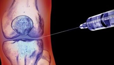 metodi di trattamento dell'artrosi articolare