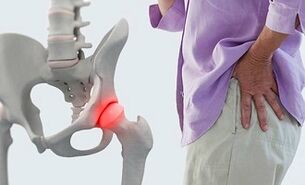 cause di artrosi dell'articolazione dell'anca