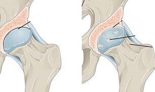 fasi di sviluppo dell'artrosi dell'anca