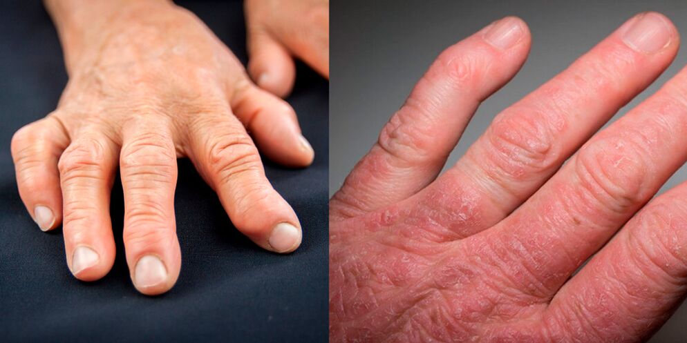 artrite reumatoide e psoriasica delle mani