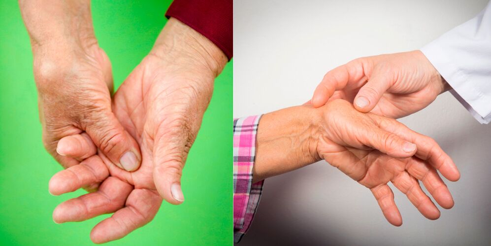 gonfiore e dolori dolorosi sono i primi segni di artrite della mano