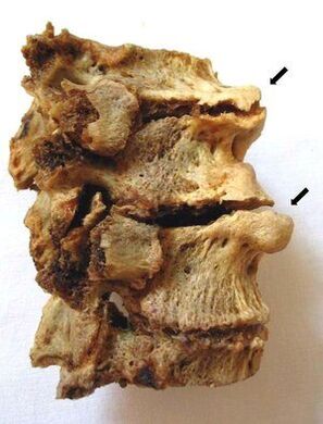 Sezione vertebrale affetta da osteocondrosi