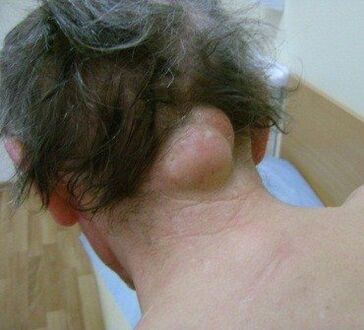 neoplasia come causa di dolore al collo