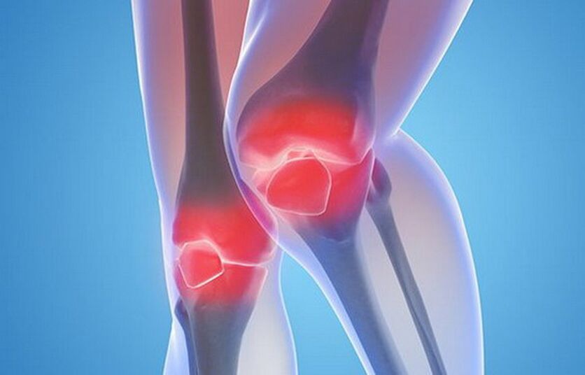 artrosi delle articolazioni del ginocchio
