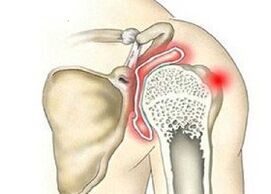 distruzione dell'articolazione della spalla con artrosi