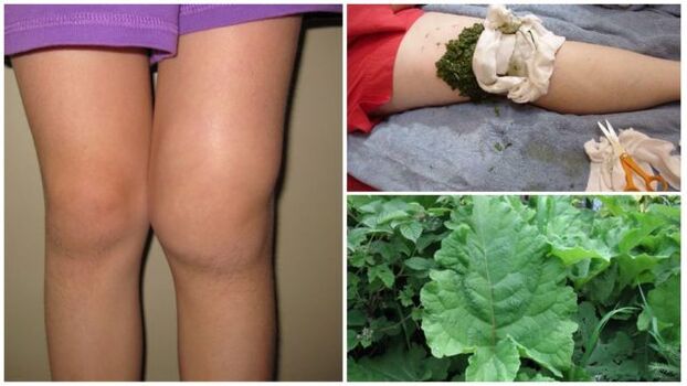 impacco a base di erbe per l'artrosi del ginocchio